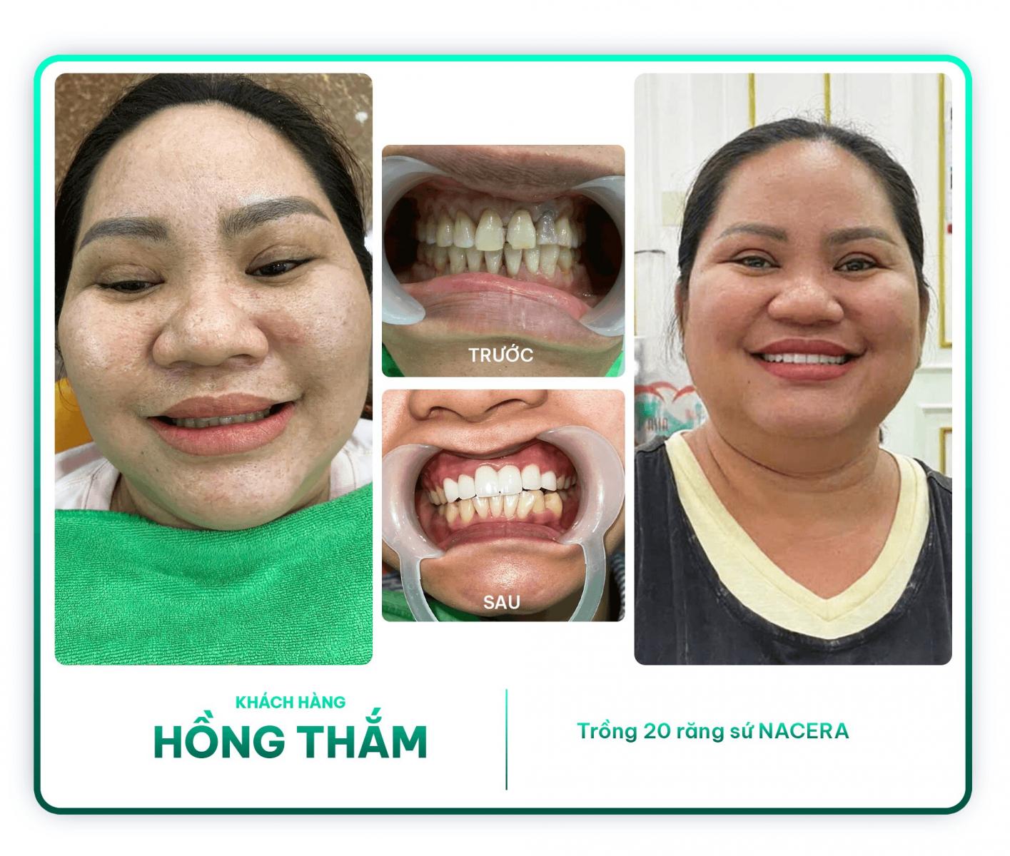 Khách hàng Hồng Thắm trồng 20 răng sứ NACERA