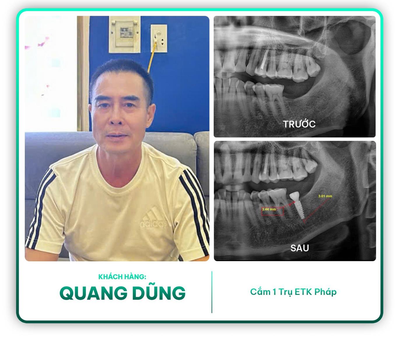 Khách hàng Quang Dũng cắm 1 trụ ETK Pháp