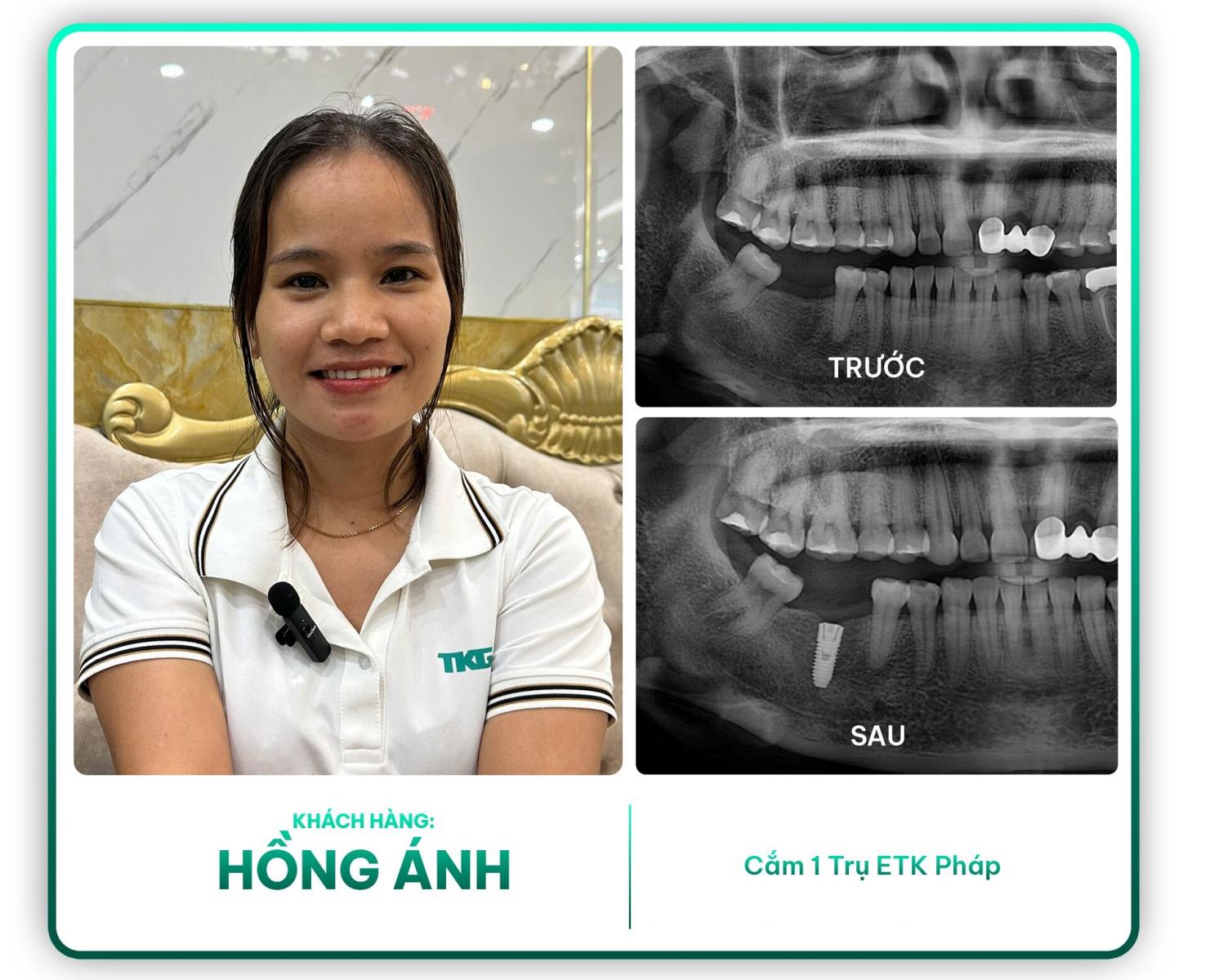 Khách hàng Hồng Ánh cắm 1 trụ ETK Pháp