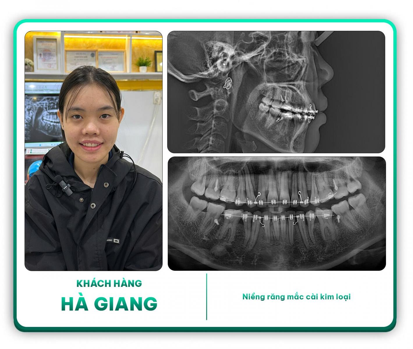 Khách hàng Hà Giang niềng răng mắc cài kim loại