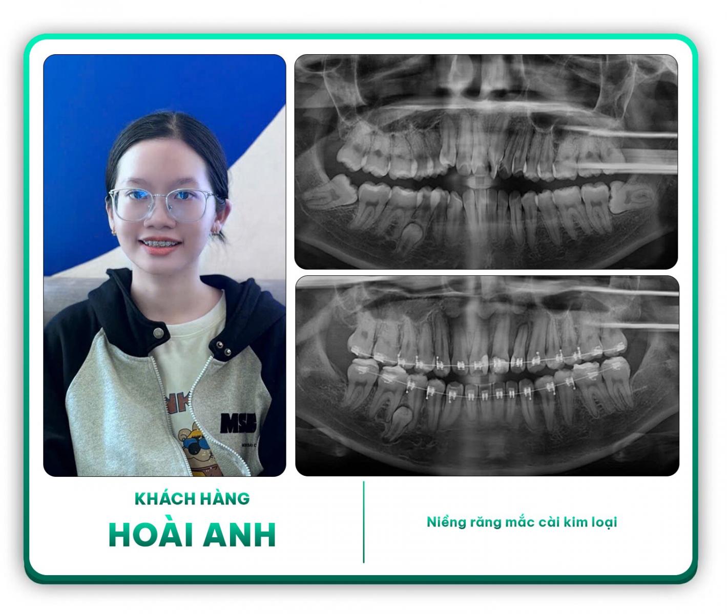 Khách hàng Hoài Ánh niềng răng mắc cài kim loại
