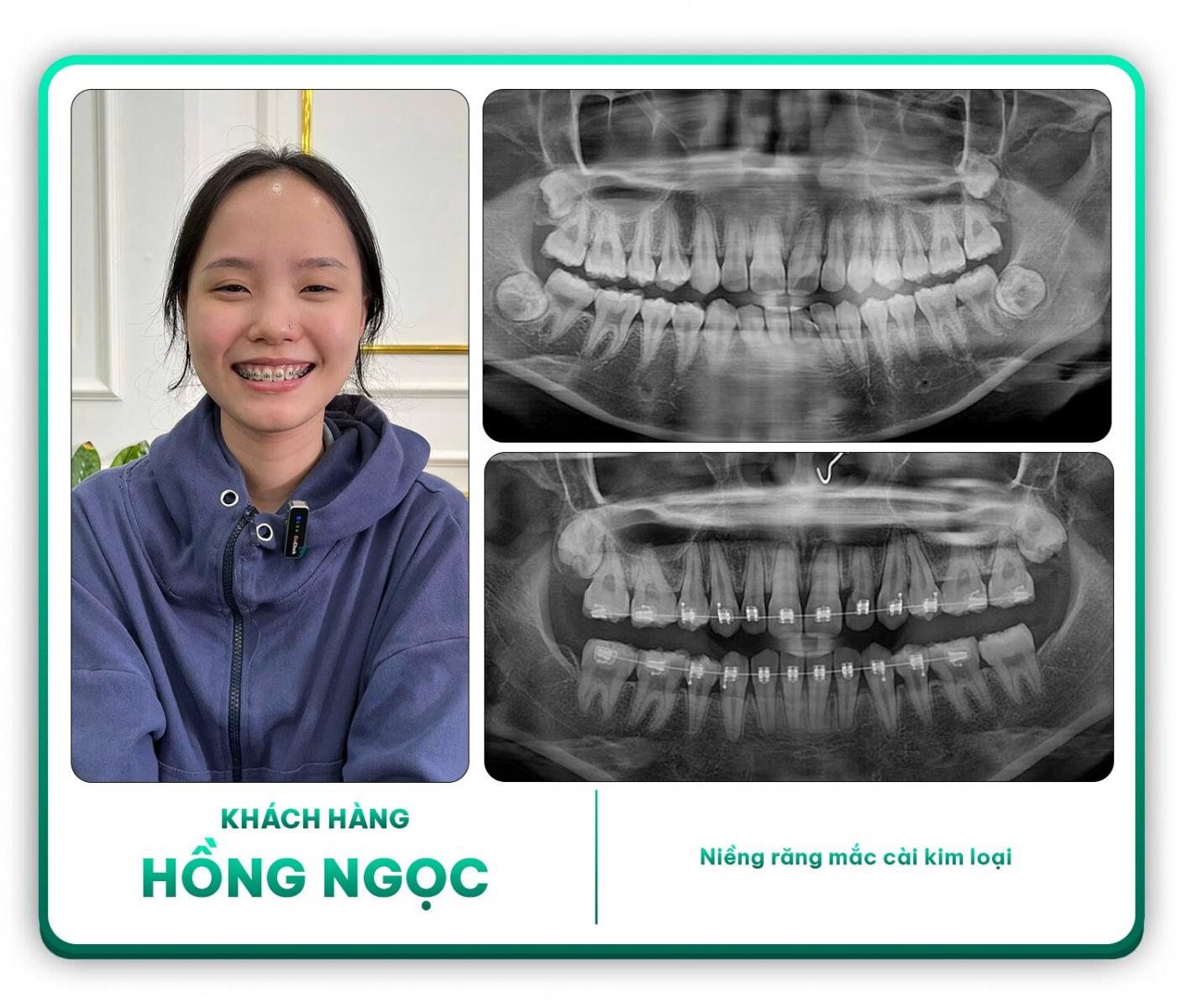 Khách hàng Hồng Ngọc niềng răng mắc cài kim loại
