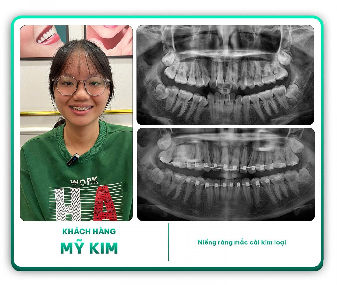 Khách hàng Mỹ Kim niềng răng mắc cài kim loại