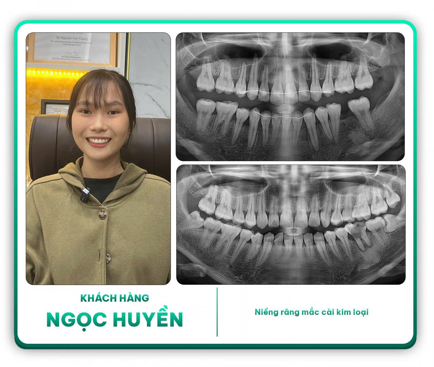 Khách hàng Ngọc Huyền niềng răng mắc cài kim loại