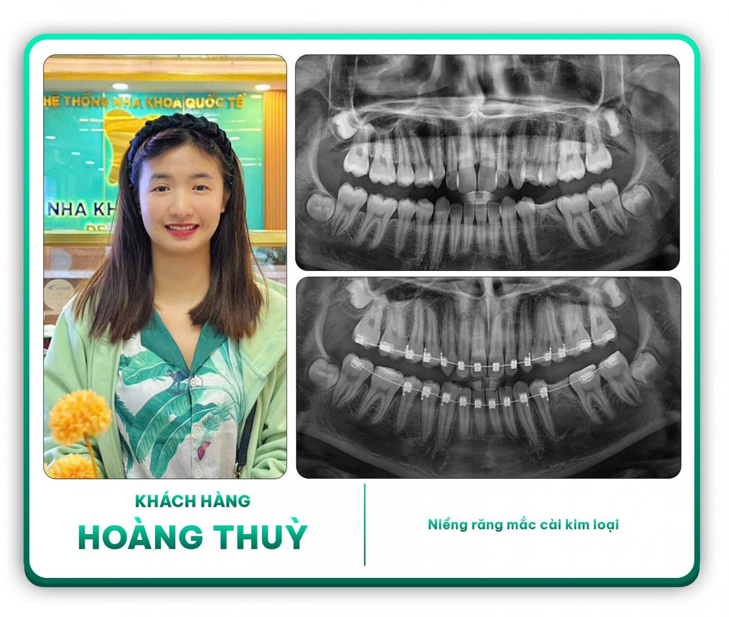 Khách hàng Hoàng Thùy niềng răng mắc cài kim loại