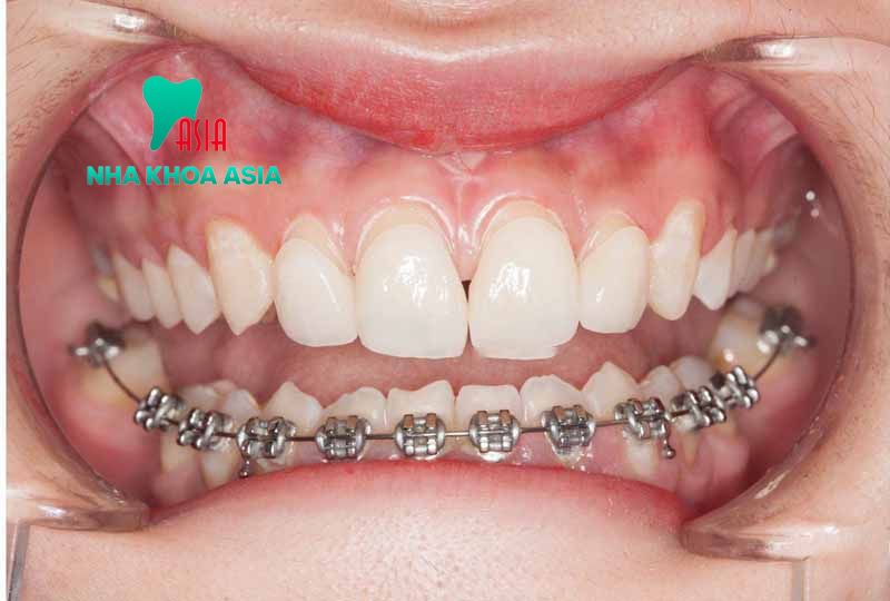 Làm thế nào để rút ngắn thời gian niềng răng