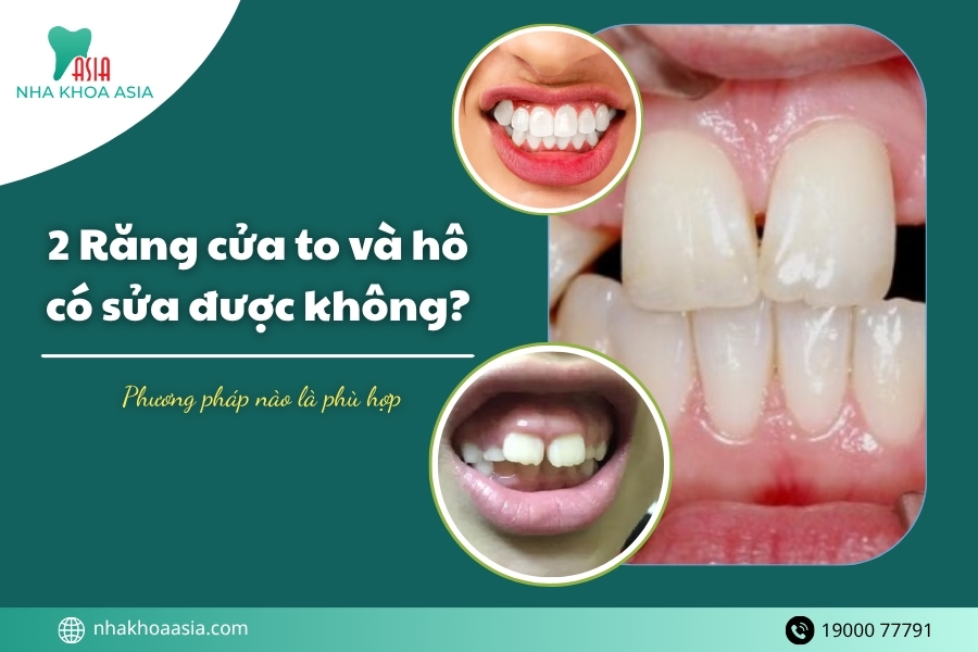 2 Răng cửa to và hô có sửa được không? Phương pháp nào là phù hợp 2026