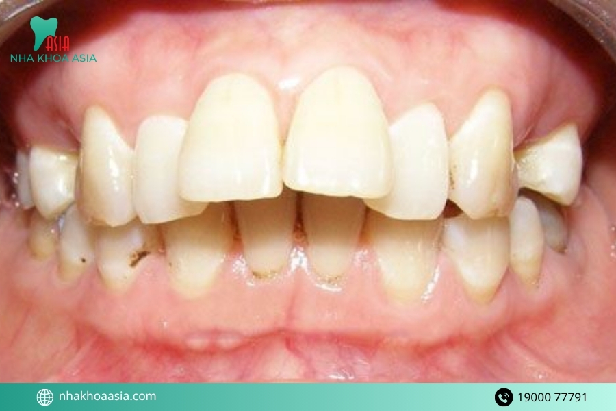 2 răng cửa to và hô có sửa được không?