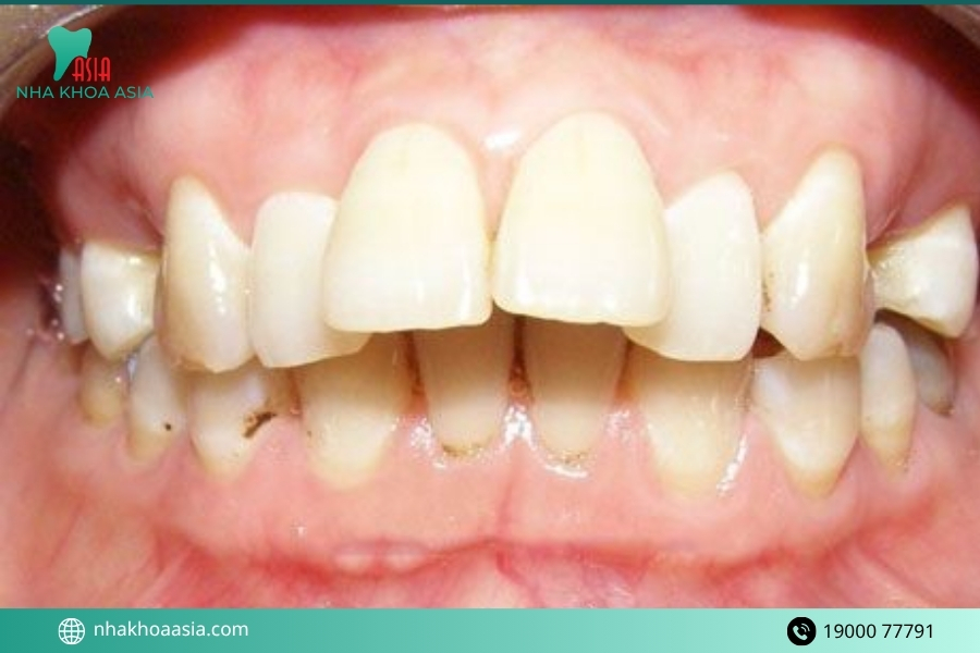 2 răng cửa to và hô có gây ảnh hưởng gì không?