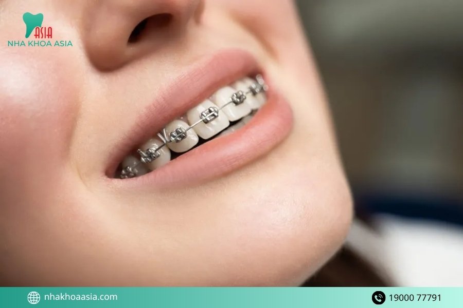 Phương pháp nào phù hợp để khắc phục 2 răng cửa to và hô?