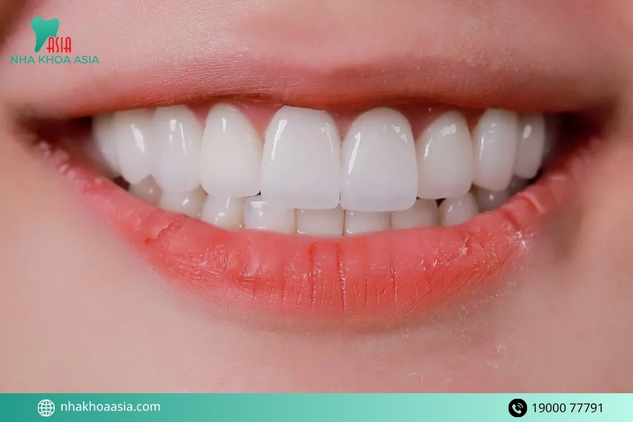 Phương pháp nào phù hợp để khắc phục 2 răng cửa to và hô?
