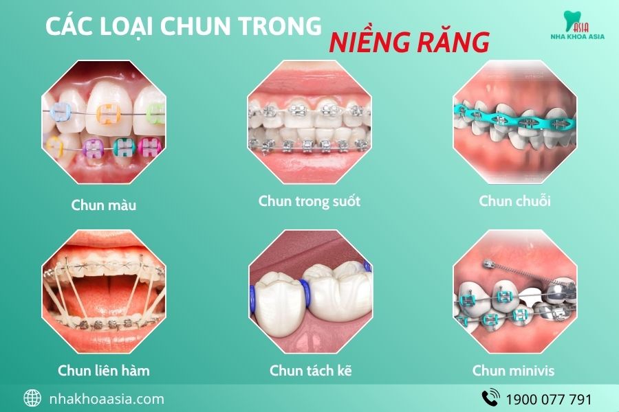 Các loại chun trong niềng răng Nha Khoa Asia
