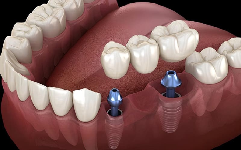 Quy Trình Thực Hiện Cầu Răng Sứ
