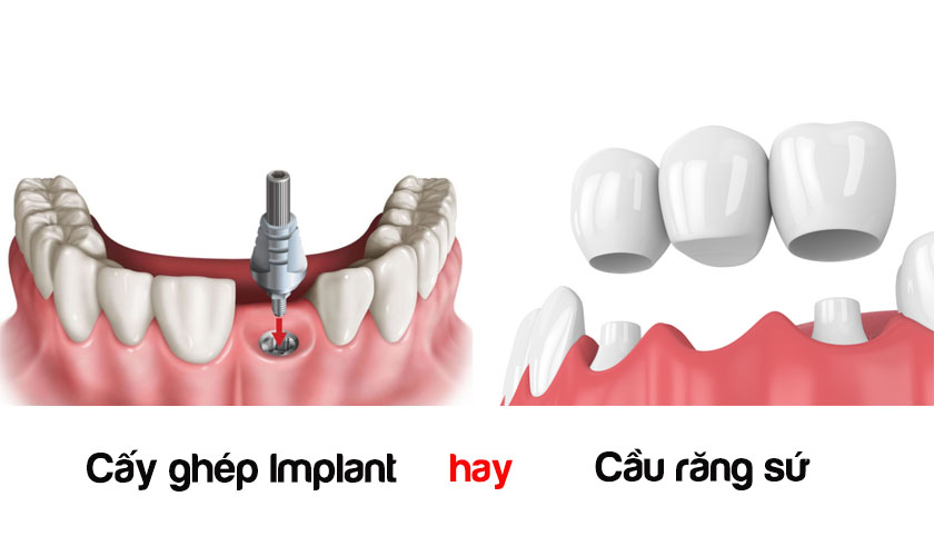 Ưu Nhược Điểm Của Cầu Răng Sứ