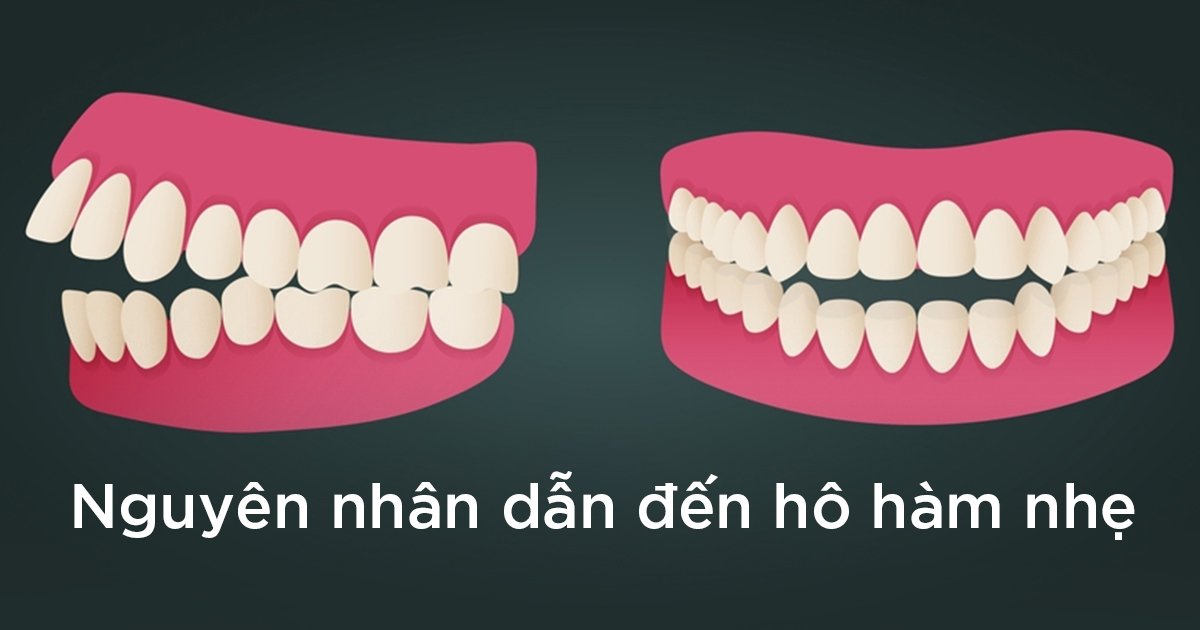 Có niềng răng để cải thiện được không