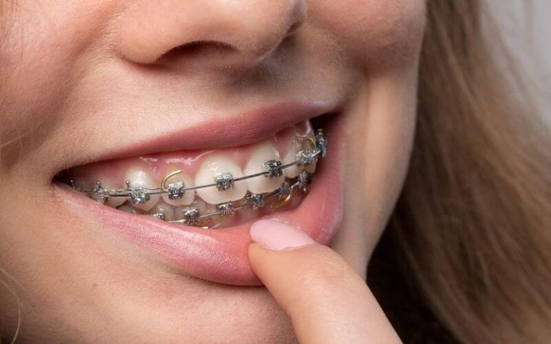 Phương pháp niềng răng hô hàm nhẹ