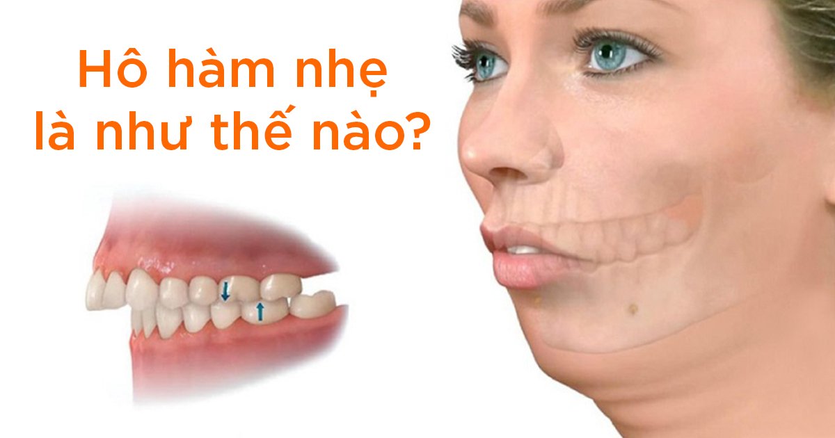 Hô hàm nhẹ là như thế nào