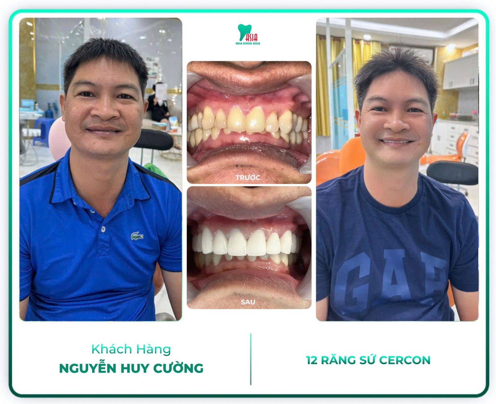 Hình ảnh khách hàng đã điều trị răng tại Nha Khoa Asia