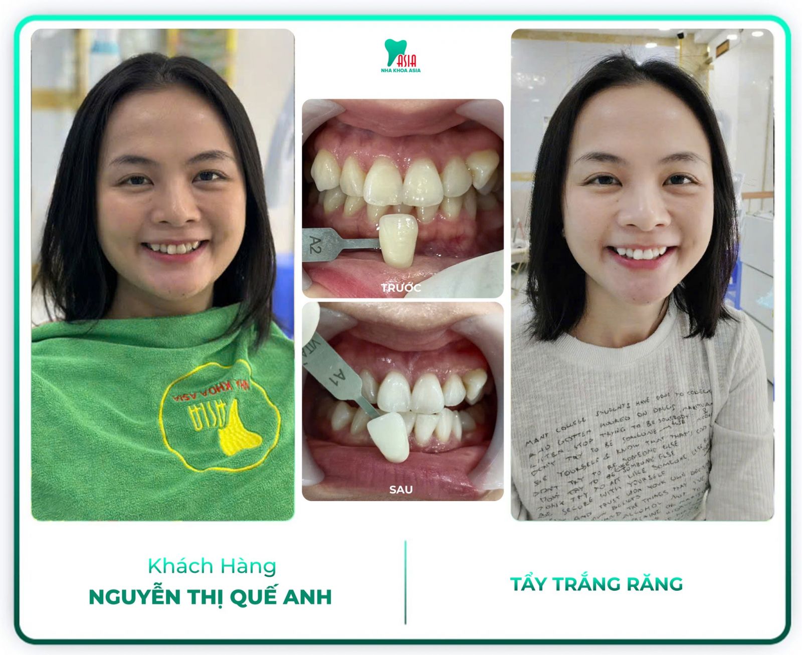 Hình ảnh khách hàng đã điều trị răng tại Nha Khoa Asia