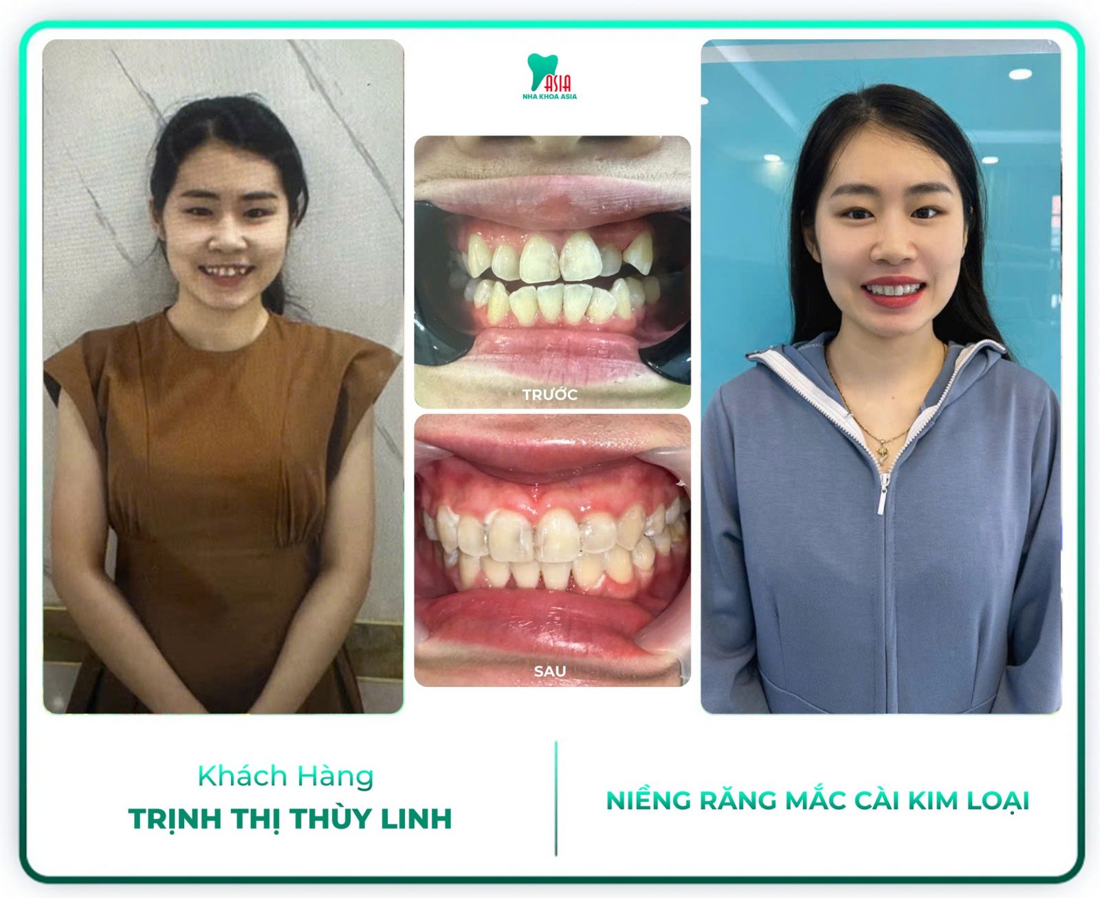 Hình ảnh khách hàng đã điều trị răng tại Nha Khoa Asia