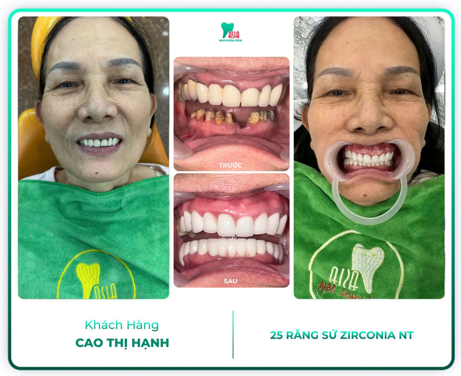 Hình ảnh khách hàng đã điều trị răng tại Nha Khoa Asia