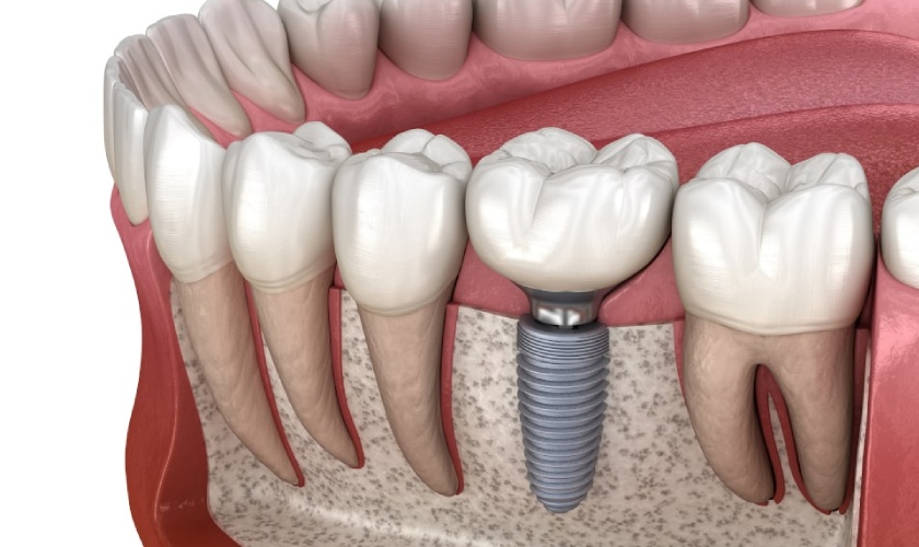 Cấy Ghép Implant Là Gì