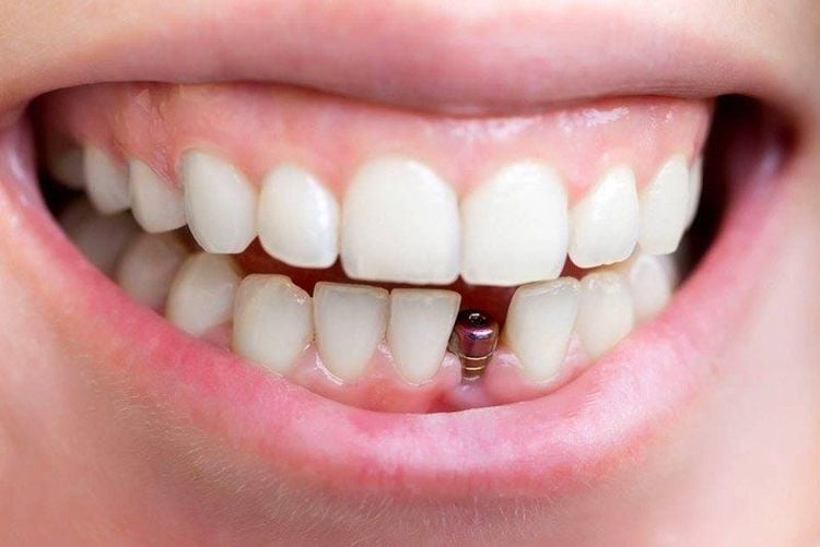 Quy Trình Cấy Ghép Implant