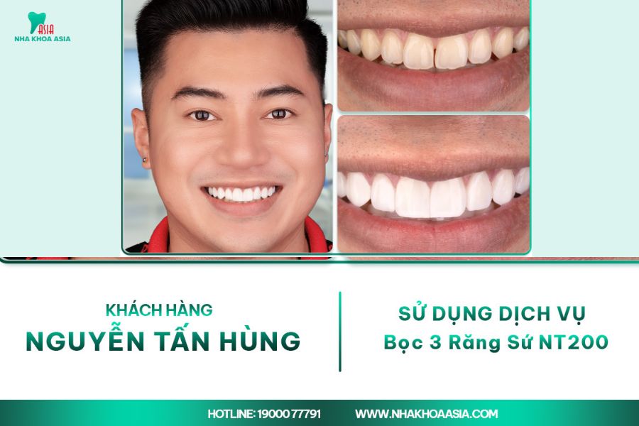 Ảnh khách hàng bọc răng sứ Nha Khoa Asia