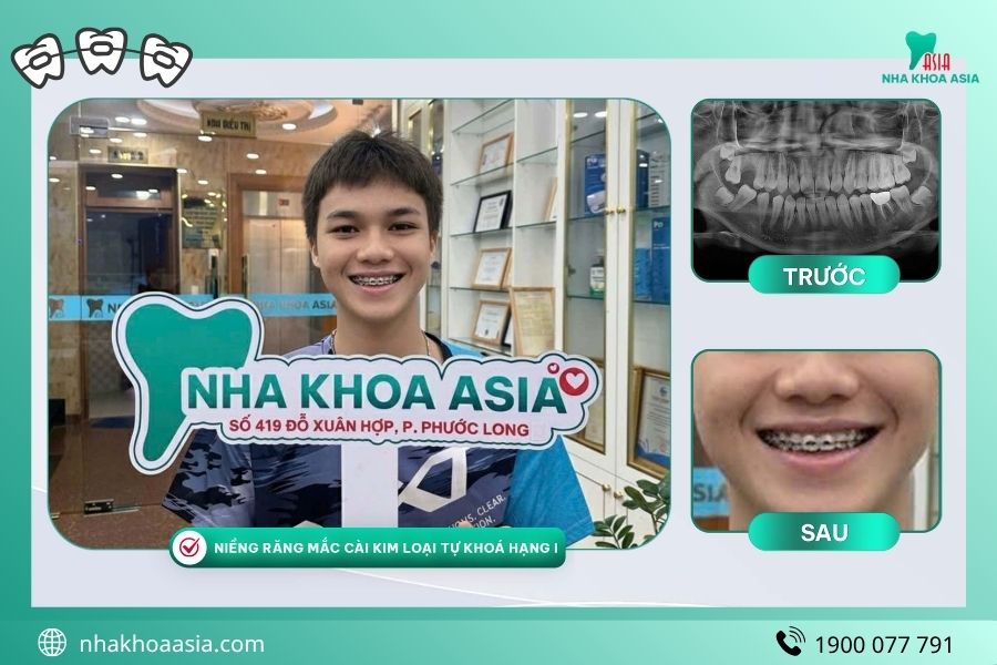 Ảnh khách hàng niềng răng Nha Khoa Asia