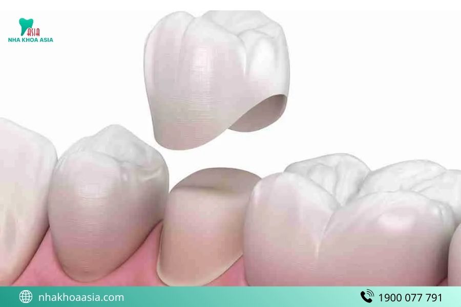 Bắc cầu răng sứ