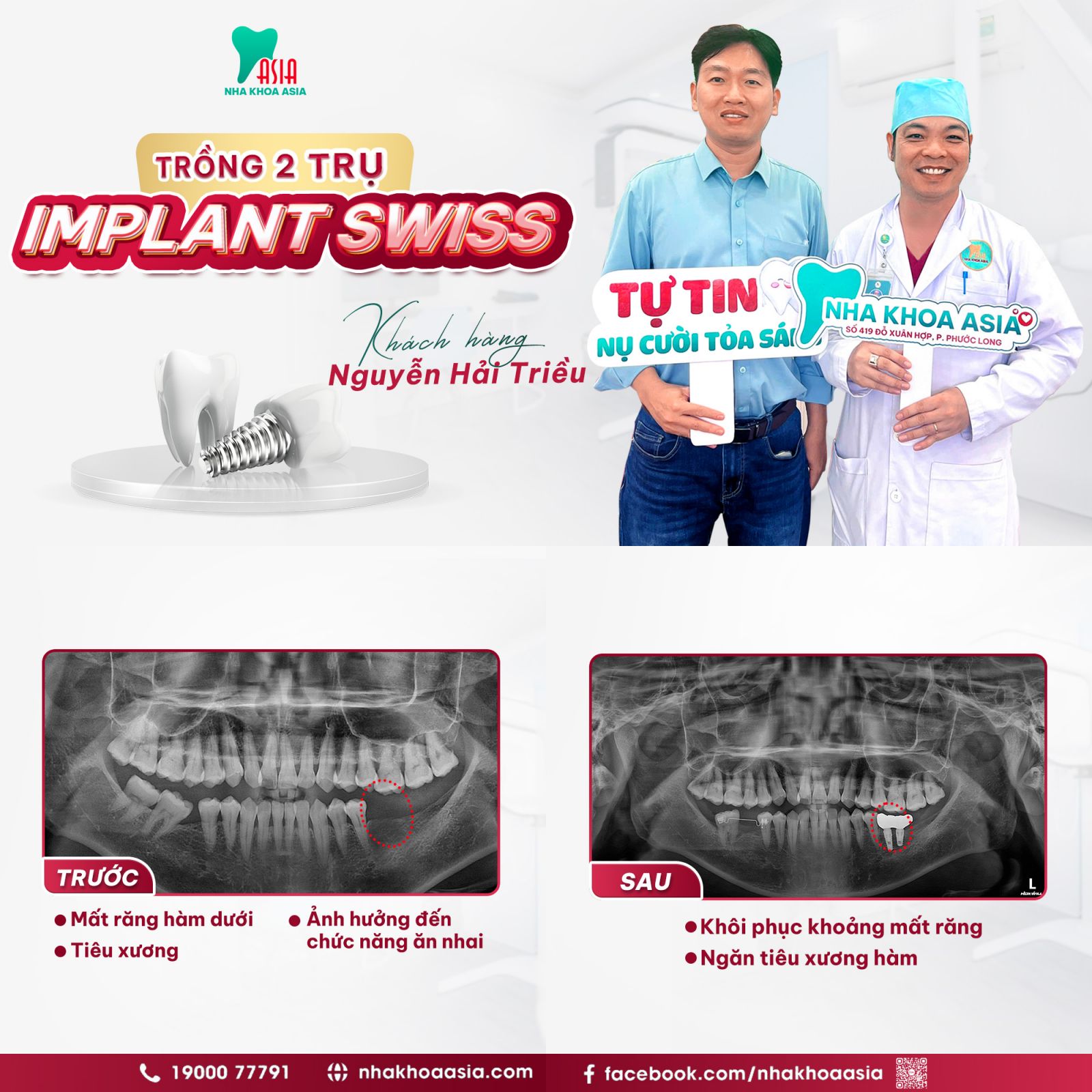 Bác sĩ Tuấn cùng khách hàng trồng 2 trụ Implant Swis