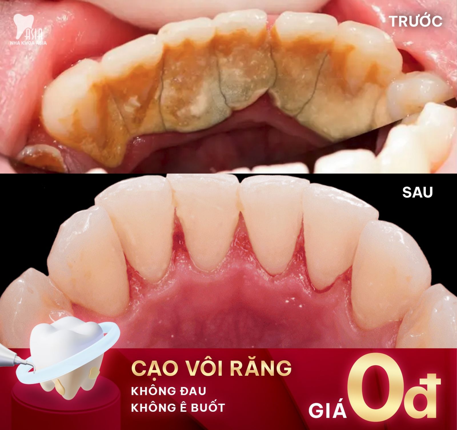 Bảng giá Cạo vôi răng sạch đẹp uy tín