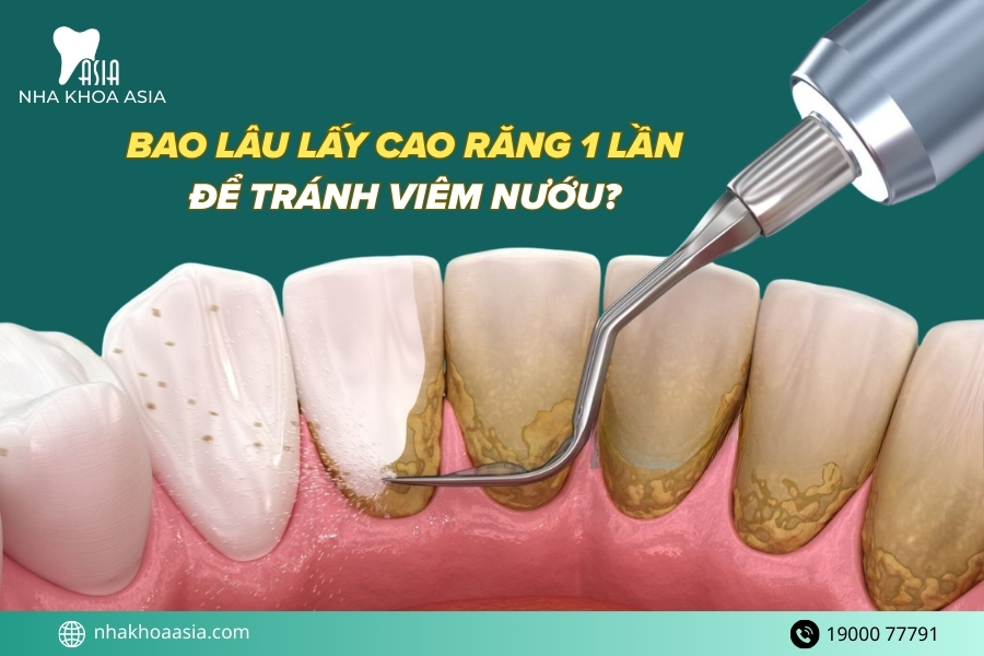 Bao lâu lấy cao răng 1 lần để tránh viêm nướu? 