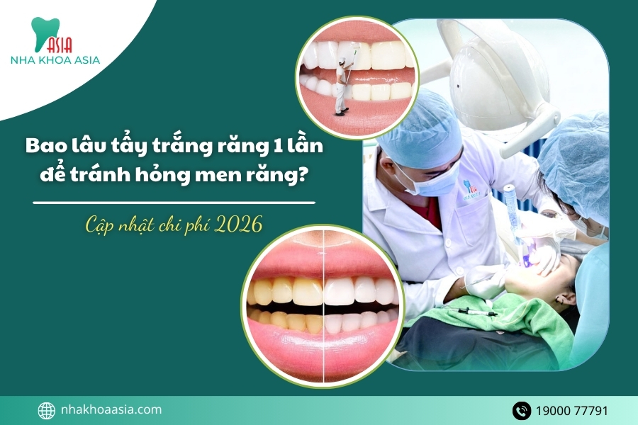 Bao lâu tẩy trắng răng 1 lần để tránh hỏng men răng? Chi phí tẩy trắng răng 2026