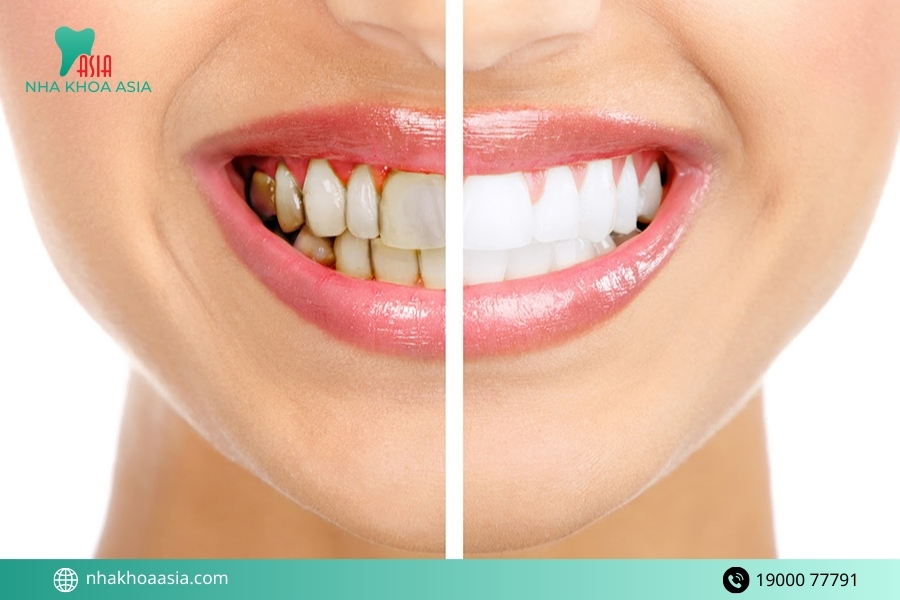 Dấu hiệu nhận biết bạn cần tới nha khoa tẩy trắng răng