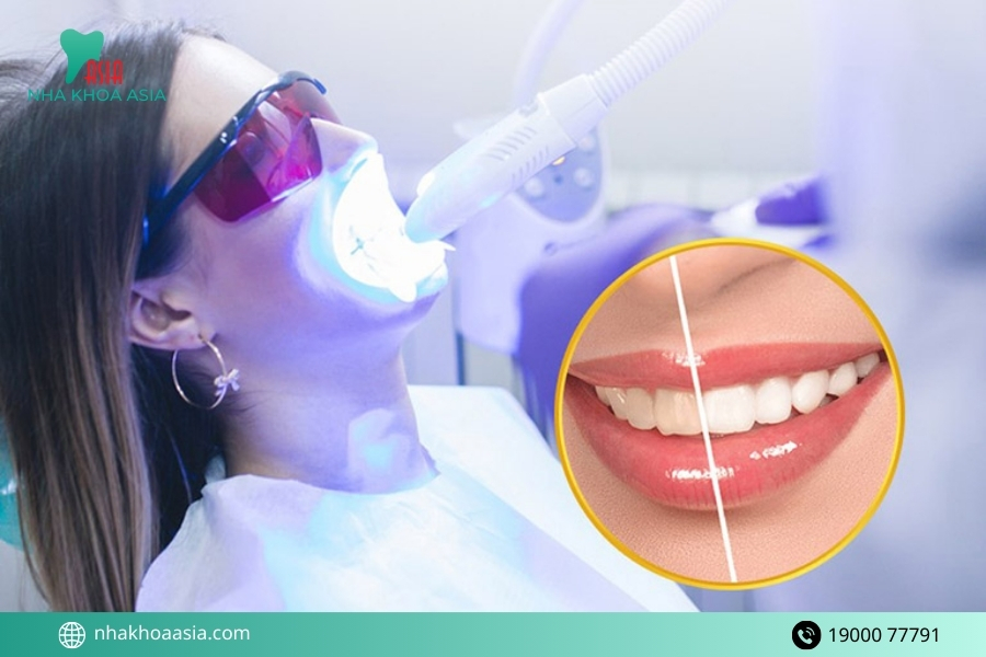 Tẩy trắng răng là gì? Bao lâu tẩy trắng răng 1 lần là an toàn và hiệu quả?