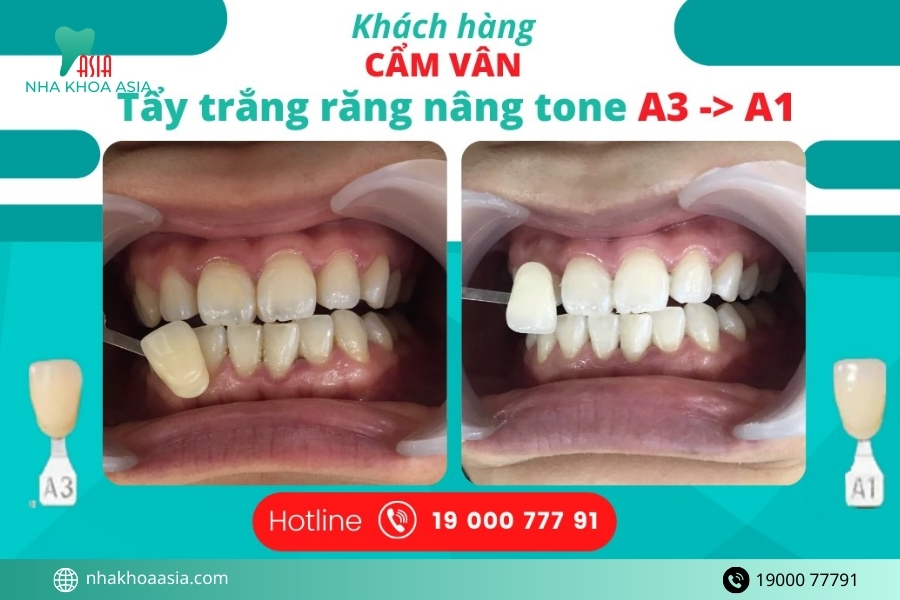 Tẩy trắng răng ở đâu uy tín, bền đẹp? Chi phí tẩy trắng răng 2026 bao nhiêu?