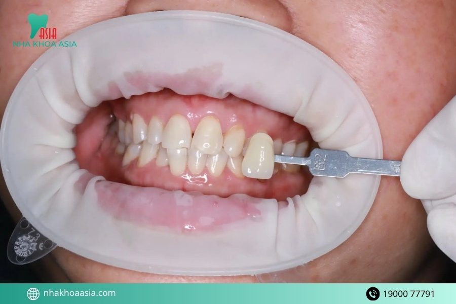 Tẩy trắng răng giữ được bao lâu?