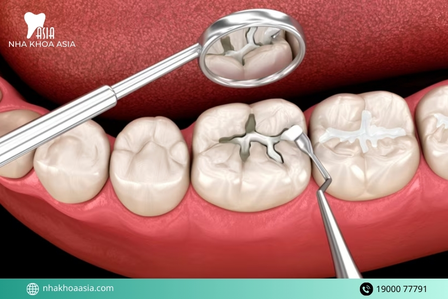 Bị ê răng sau khi trám bao lâu thì hết?