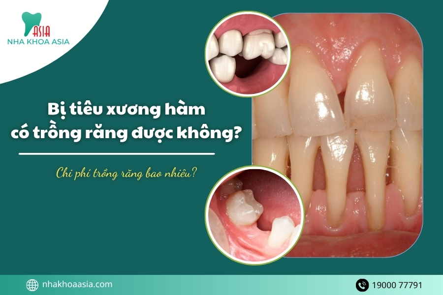 Bị tiêu xương hàm có trồng răng được không? Chi phí bao nhiêu?