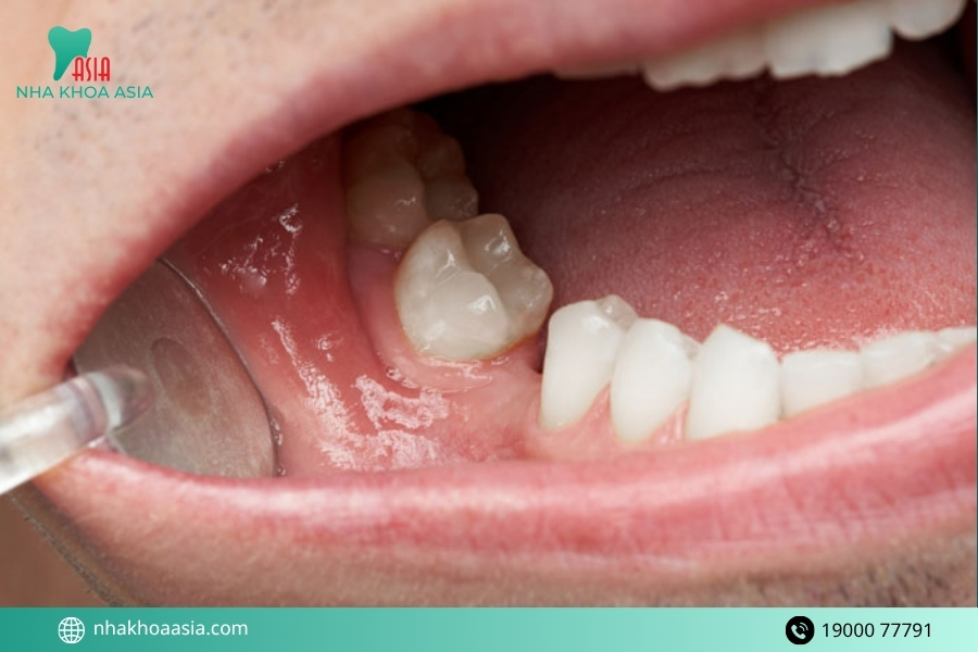 Bị tiêu xương hàm có trồng răng được không?