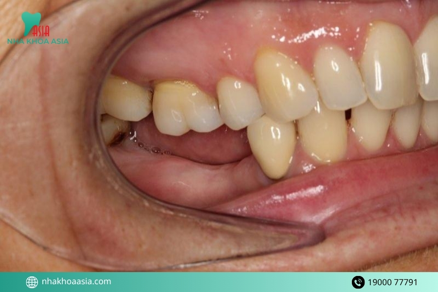 Mức độ tiêu xương hàm quyết định khả năng trồng răng như thế nào?