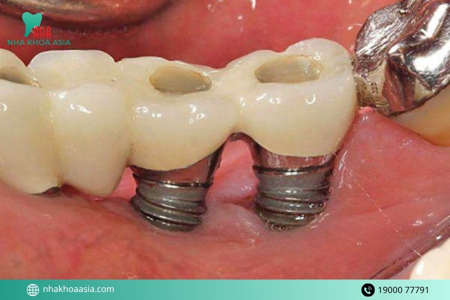 Phương pháp trồng răng khi bị tiêu xương hàm - Trồng răng Implant