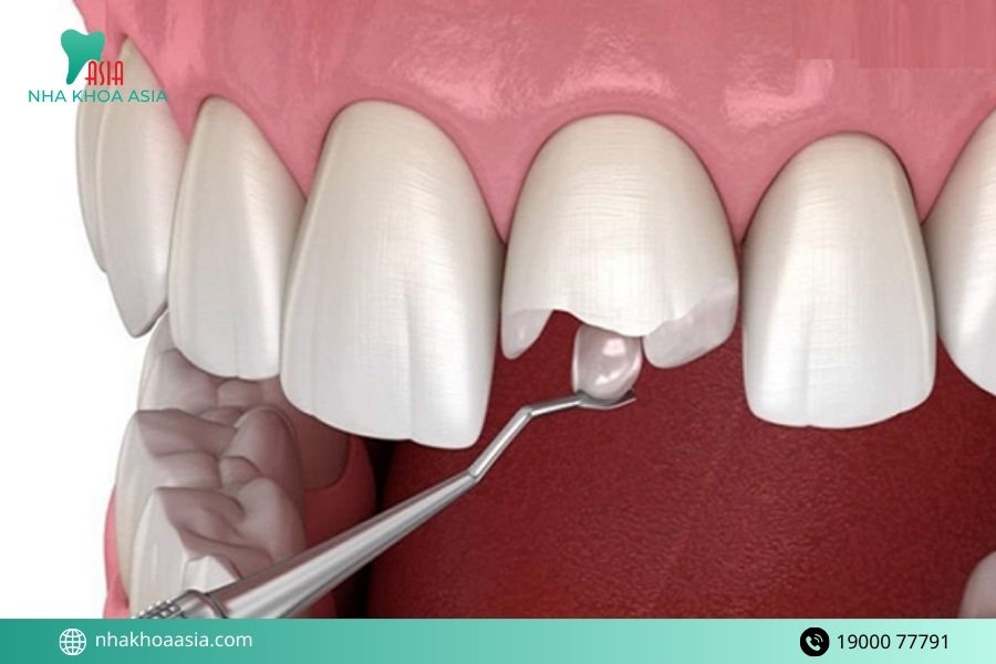 Biến chứng có thể gặp nếu bị ê răng sau khi trám kéo dài