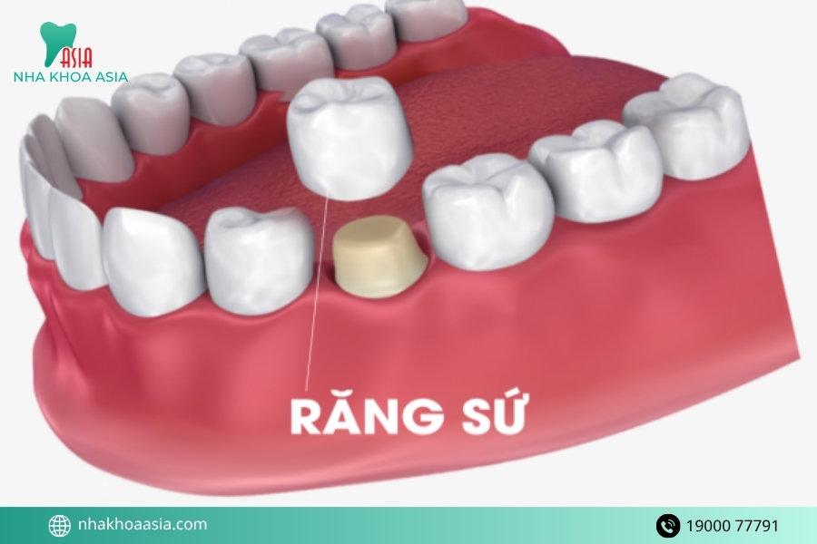 Làm thế nào để phòng tránh biến chứng sau khi bọc răng sứ?