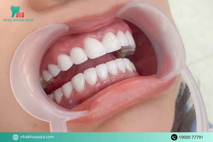 Những cách xử lý biến chứng sau khi bọc răng sứ
