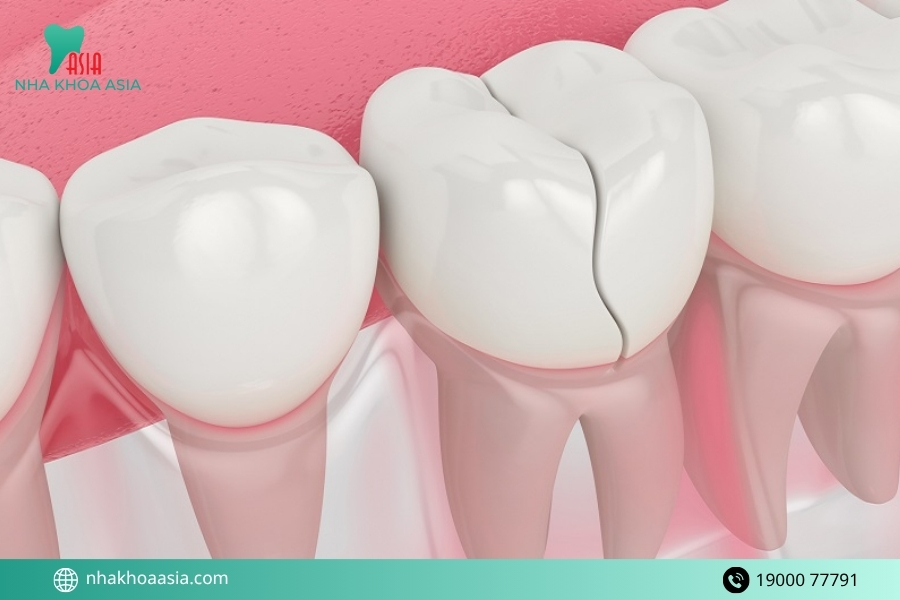 Biến chứng sau khi bọc răng sứ nguy hiểm nếu không xử lý kịp