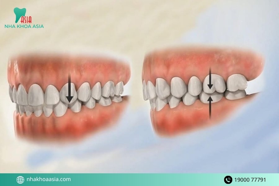 Biến chứng sau khi bọc răng sứ nguy hiểm nếu không xử lý kịp