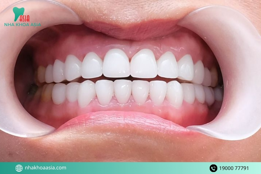 Biến chứng sau khi bọc răng sứ có nguy hiểm không?