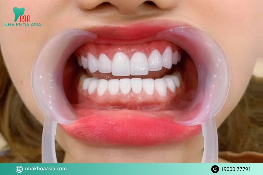 Cách phòng tránh bọc răng sứ bị đau chân răng